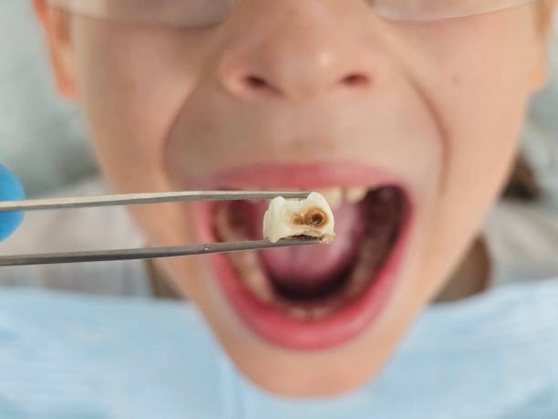 Best Dental Abscess Treatment in South Wallins, KY